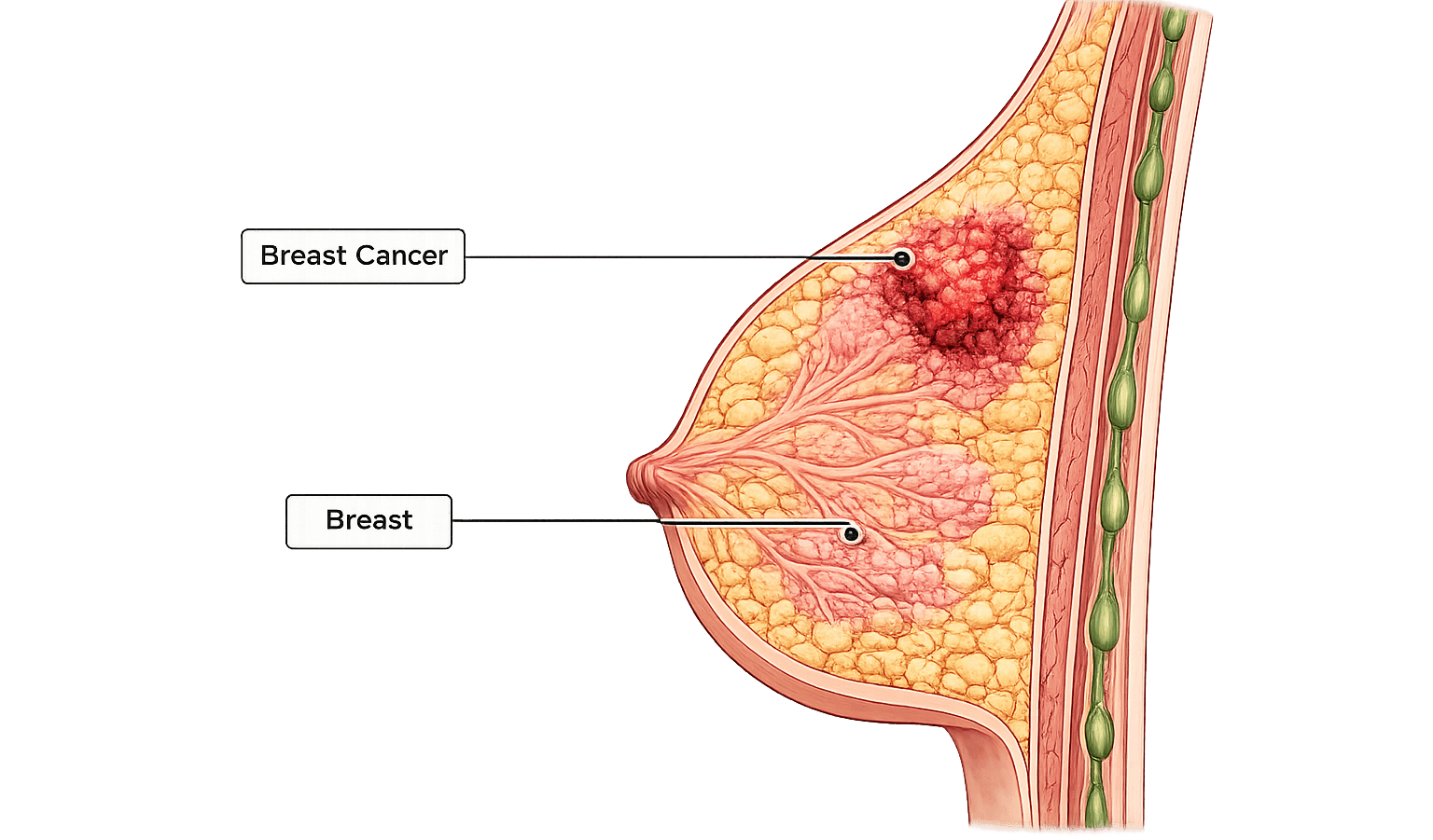 Breast Cancer