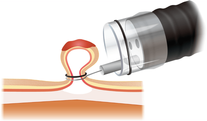 Endoscopic Resection
